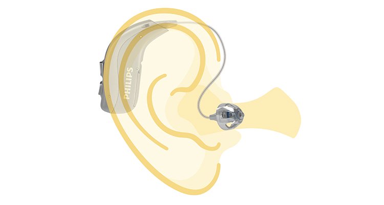 一幅清晰标明飞利浦HearLink耳背式助听器佩戴位置的图
