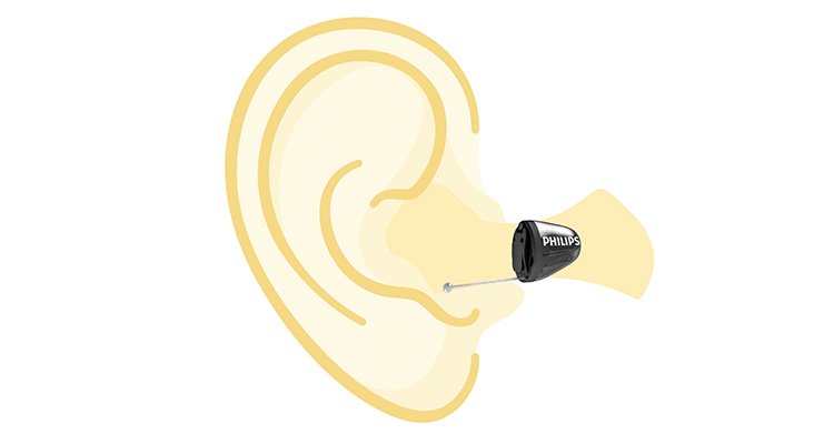 一幅清晰标明飞利浦HearLink耳道式助听器在耳朵内位置的图